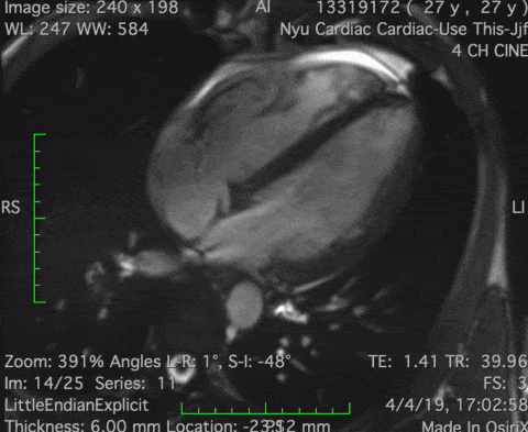 A looping cardiac MRI of my own heart beating, seen in a four-chamber view.
